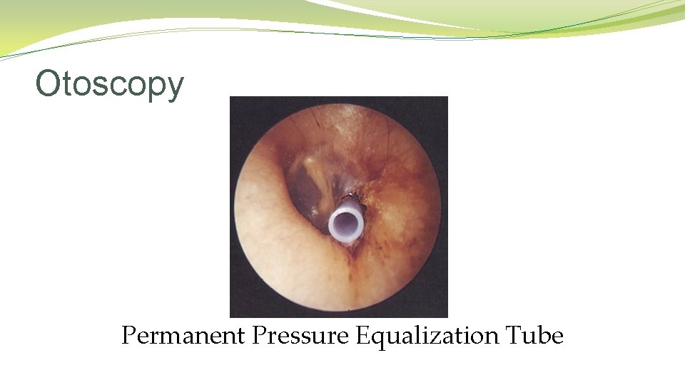 Otoscopy Permanent Pressure Equalization Tube Otoscopy Permanent Pressure Equalization Tube