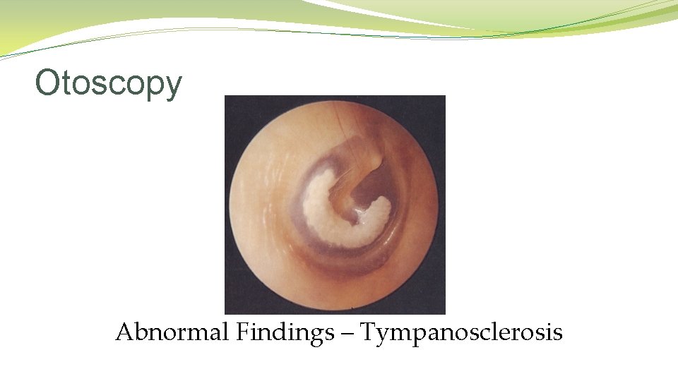 Otoscopy Abnormal Findings – Tympanosclerosis Otoscopy Abnormal Findings – Tympanosclerosis