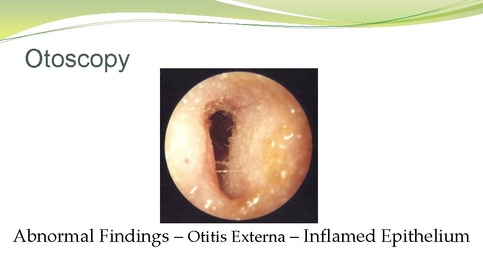 Otoscopy Abnormal Findings – Otitis Externa – Inflamed Epithelium Otoscopy Abnormal Findings – Otitis Externa – Inflamed Epithelium