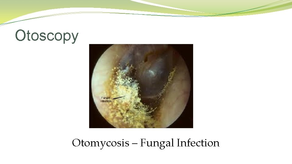 Otoscopy Otomycosis – Fungal Infection Otoscopy Otomycosis – Fungal Infection