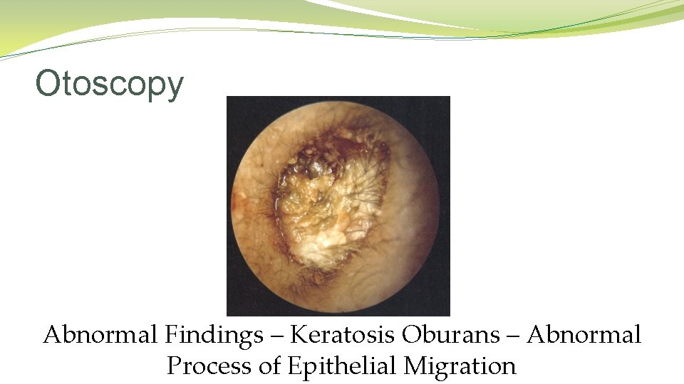 Otoscopy Abnormal Findings – Keratosis Oburans – Abnormal Process of Epithelial Migration Otoscopy Abnormal Findings – Keratosis Oburans – Abnormal Process of Epithelial Migration