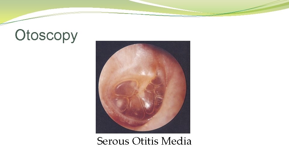 Otoscopy Serous Otitis Media Otoscopy Serous Otitis Media