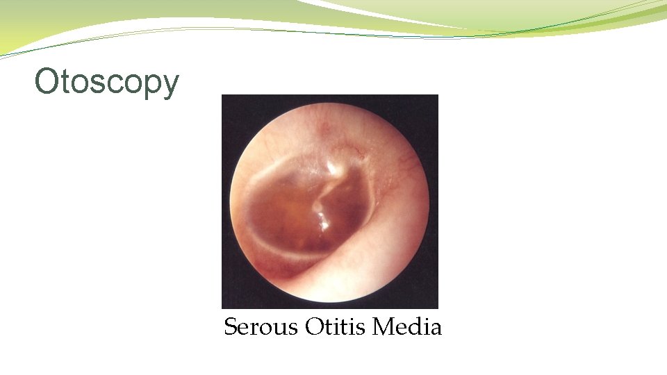Otoscopy Serous Otitis Media Otoscopy Serous Otitis Media