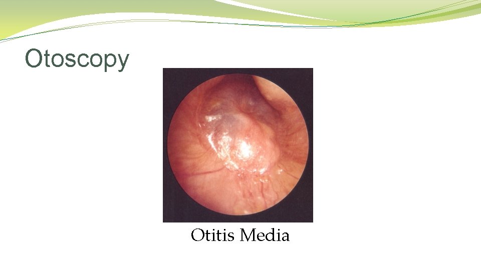Otoscopy Otitis Media Otoscopy Otitis Media