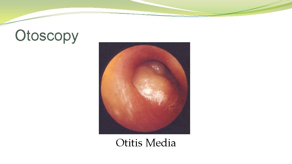 Otoscopy Otitis Media Otoscopy Otitis Media