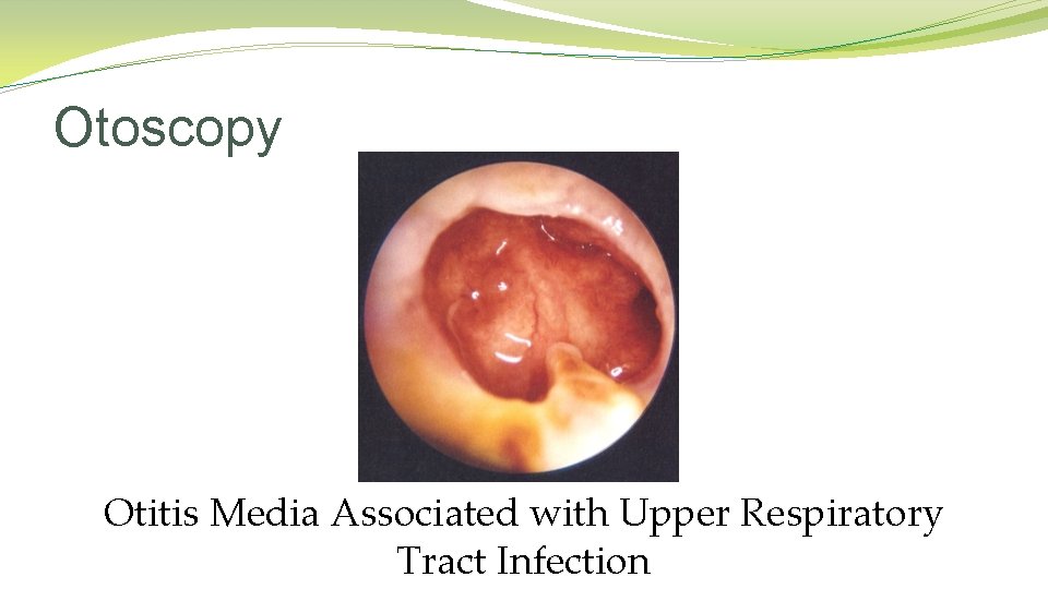 Otoscopy Otitis Media Associated with Upper Respiratory Tract Infection Otoscopy Otitis Media Associated with Upper Respiratory Tract Infection
