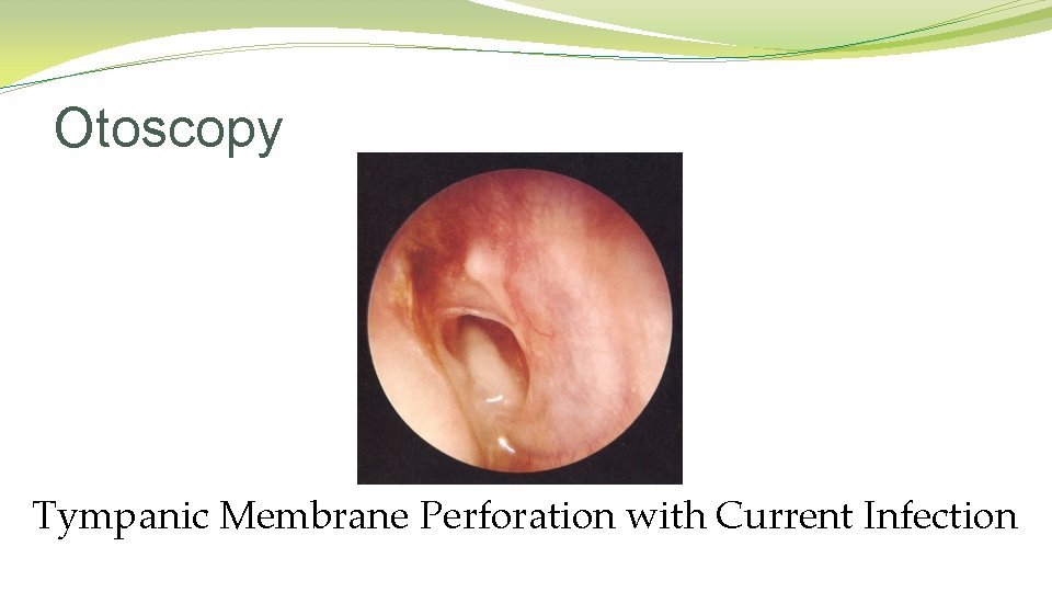 Otoscopy Tympanic Membrane Perforation with Current Infection Otoscopy Tympanic Membrane Perforation with Current Infection