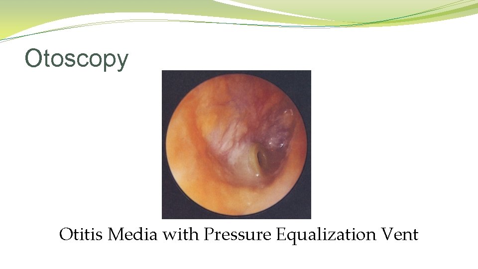 Otoscopy Otitis Media with Pressure Equalization Vent Otoscopy Otitis Media with Pressure Equalization Vent
