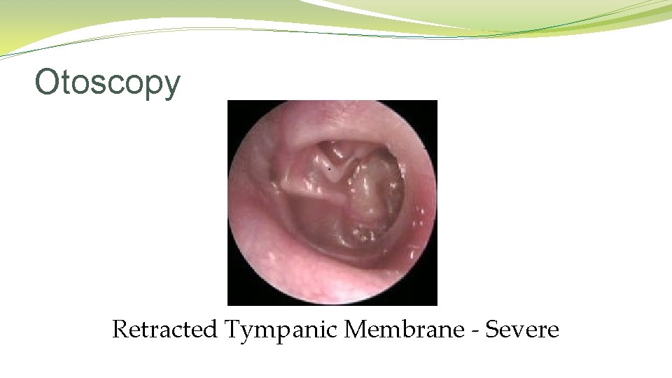 Otoscopy Retracted Tympanic Membrane - Severe Otoscopy Retracted Tympanic Membrane - Severe