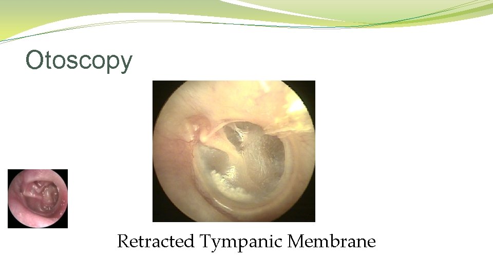 Otoscopy Retracted Tympanic Membrane Otoscopy Retracted Tympanic Membrane