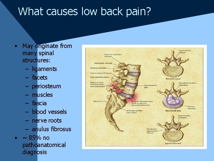 What causes low back pain? • May originate from many spinal structures: – ligaments