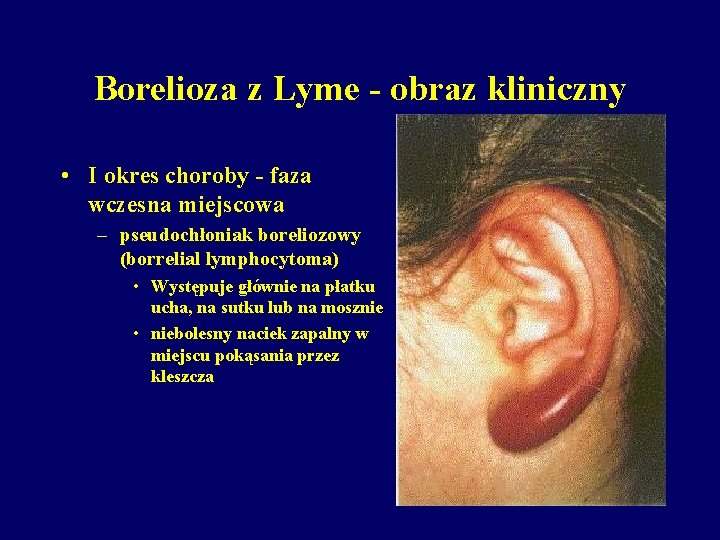 Borelioza z Lyme - obraz kliniczny • I okres choroby - faza wczesna miejscowa