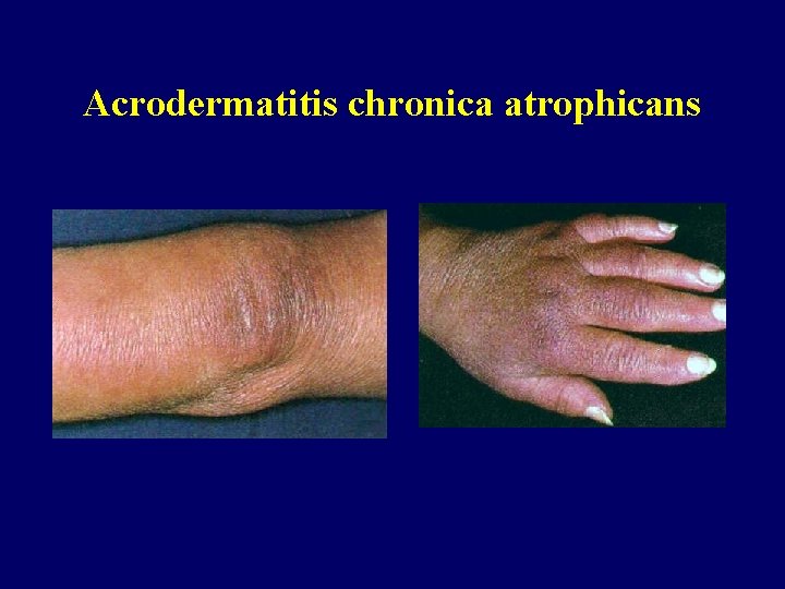 Acrodermatitis chronica atrophicans 