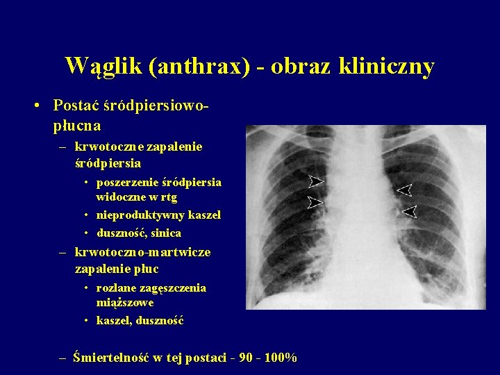 Wąglik (anthrax) - obraz kliniczny • Postać śródpiersiowopłucna – krwotoczne zapalenie śródpiersia • poszerzenie