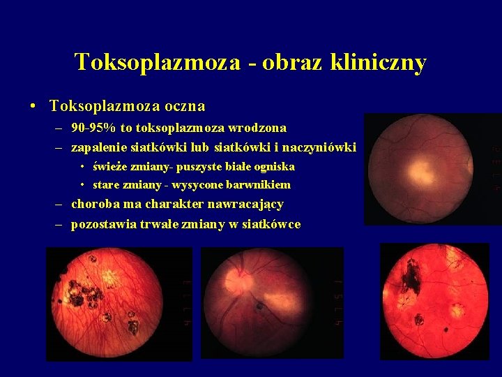 Toksoplazmoza - obraz kliniczny • Toksoplazmoza oczna – 90 -95% to toksoplazmoza wrodzona –