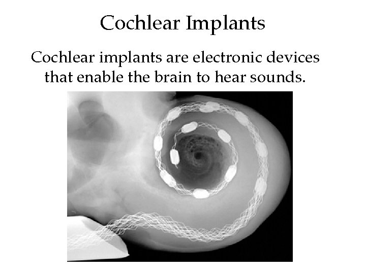 Cochlear Implants Cochlear implants are electronic devices that enable the brain to hear sounds.