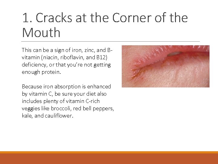 1. Cracks at the Corner of the Mouth This can be a sign of