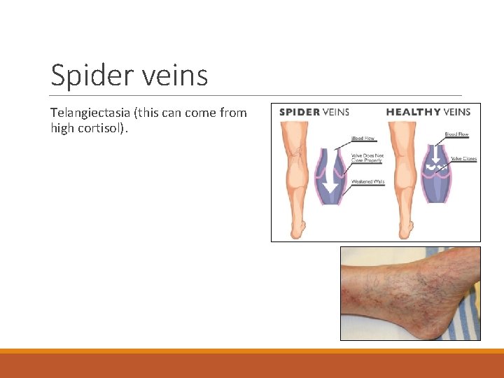 Spider veins Telangiectasia (this can come from high cortisol). 