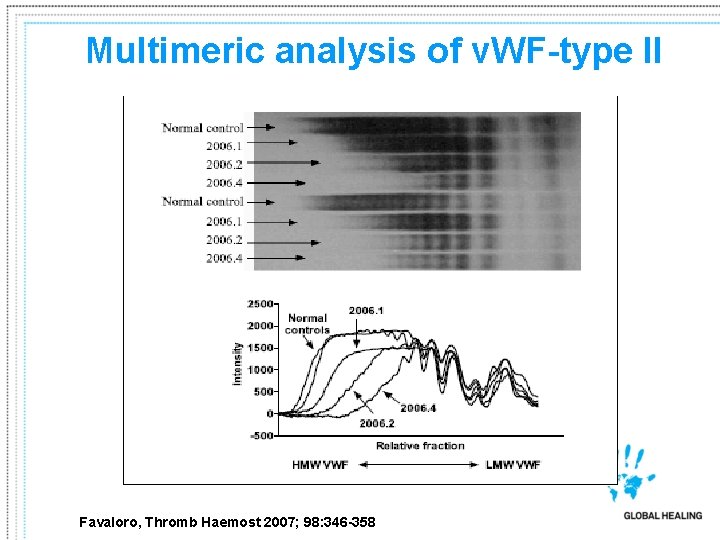 Multimeric analysis of v. WF-type II Favaloro, Thromb Haemost 2007; 98: 346 -358 