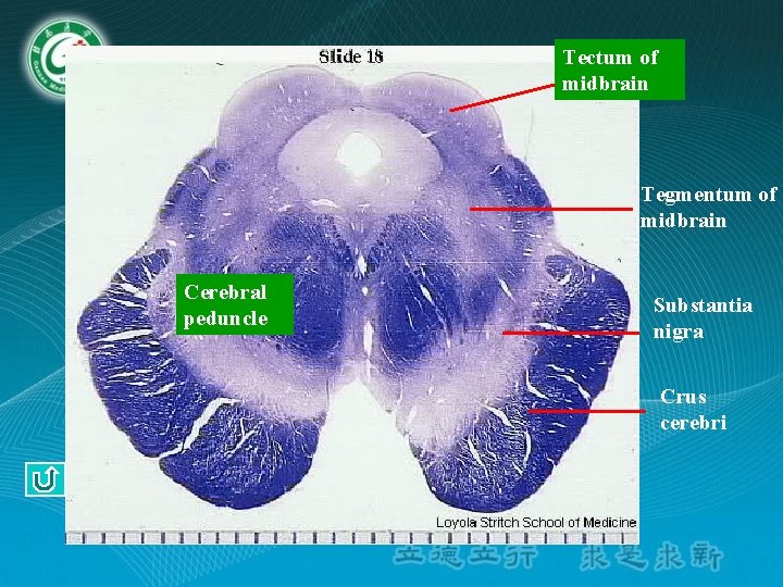 Tectum of midbrain Tegmentum of midbrain Cerebral peduncle Substantia nigra Crus cerebri Tectum of midbrain Tegmentum of midbrain Cerebral peduncle Substantia nigra Crus cerebri