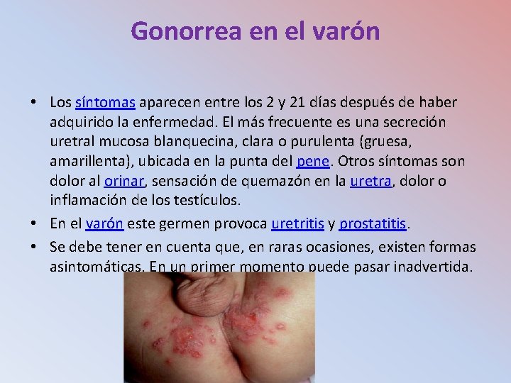 Gonorrea en el varón • Los síntomas aparecen entre los 2 y 21 días