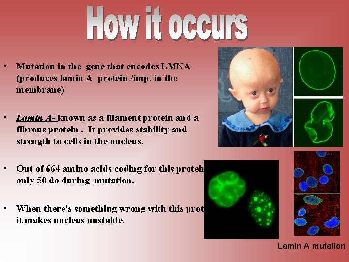  • Mutation in the gene that encodes LMNA (produces lamin A protein /imp.