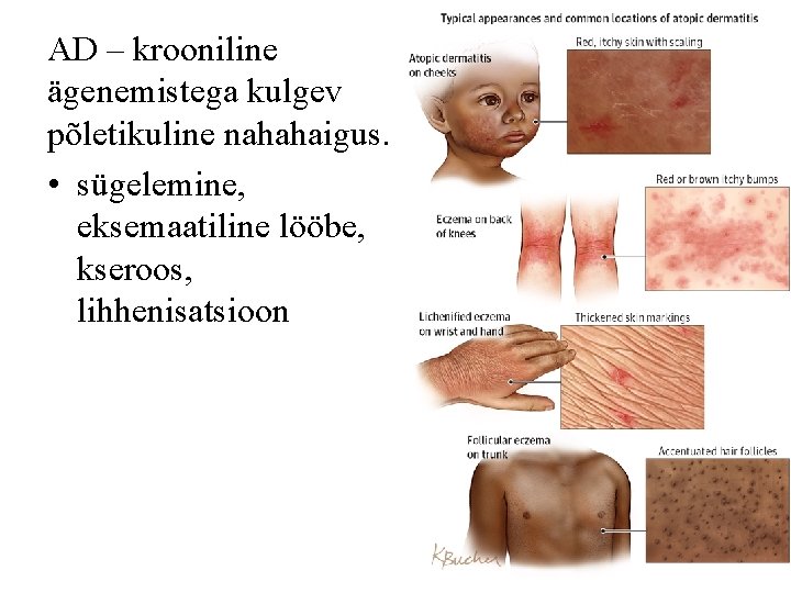 AD – krooniline ägenemistega kulgev põletikuline nahahaigus. • sügelemine, eksemaatiline lööbe, kseroos, lihhenisatsioon 