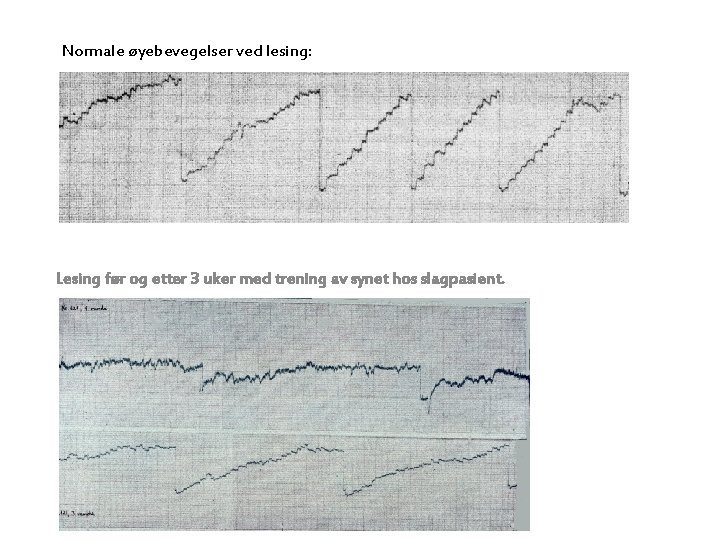 Normale øyebevegelser ved lesing: Lesing før og etter 3 uker med trening av synet