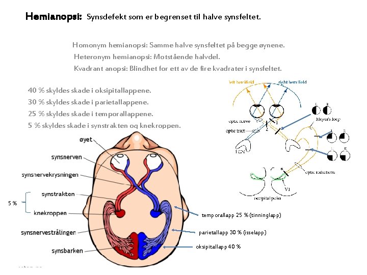Hemianopsi: Synsdefekt som er begrenset til halve synsfeltet. Homonym hemianopsi: Samme halve synsfeltet på