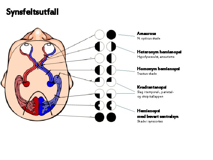 Synsfeltsutfall Amaurosa N. opticus skade Heteronym hemianopsi Hypofysesvulst, aneurisme Homonym hemianopsi Tractus-skade Kvadrantanopsi Slag