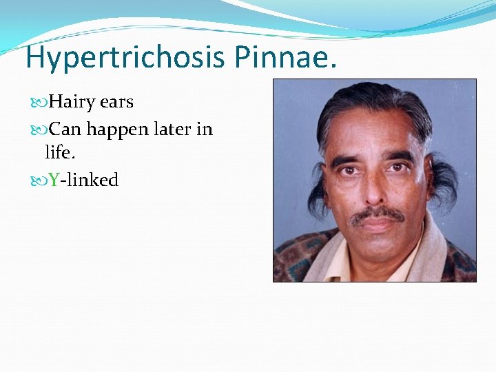 Hypertrichosis Pinnae. Hairy ears Can happen later in life. Y-linked 