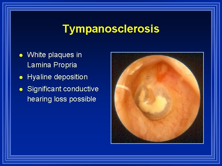 Tympanosclerosis l White plaques in Lamina Propria l Hyaline deposition l Significant conductive hearing
