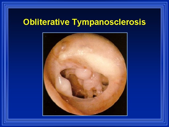 Obliterative Tympanosclerosis 