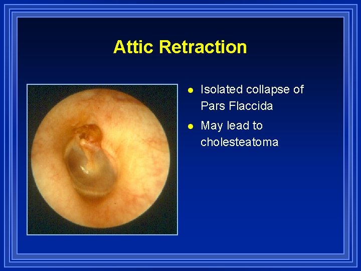 Attic Retraction l Isolated collapse of Pars Flaccida l May lead to cholesteatoma 