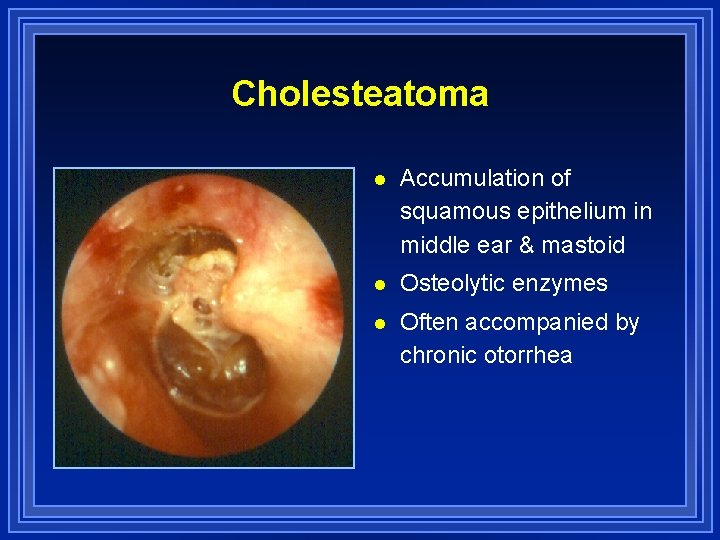 Cholesteatoma l Accumulation of squamous epithelium in middle ear & mastoid l Osteolytic enzymes