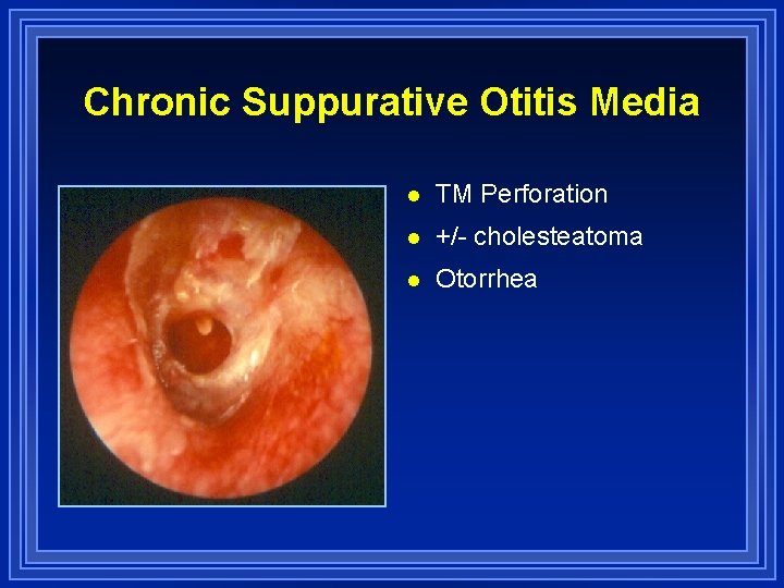 Chronic Suppurative Otitis Media l TM Perforation l +/- cholesteatoma l Otorrhea 