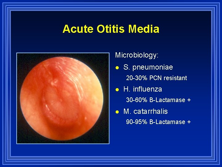 Acute Otitis Media Microbiology: l S. pneumoniae 20 -30% PCN resistant l H. influenza