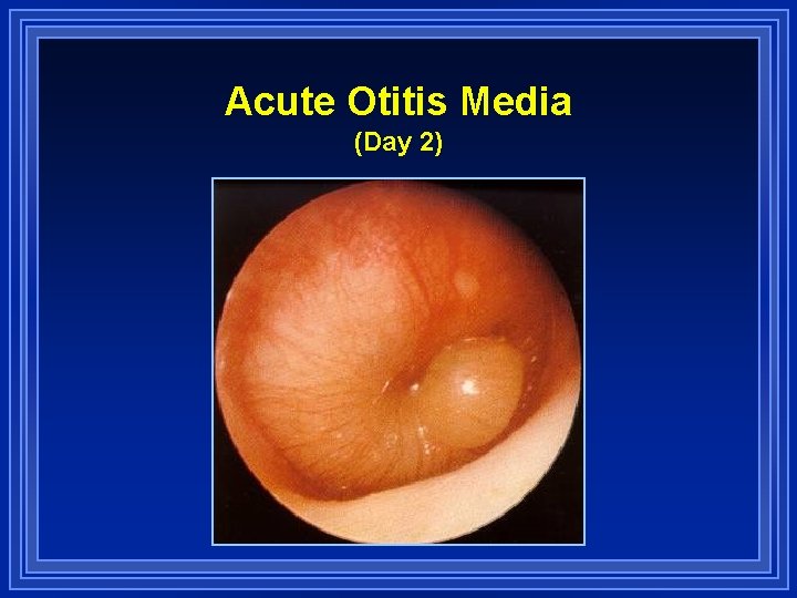 Acute Otitis Media (Day 2) 