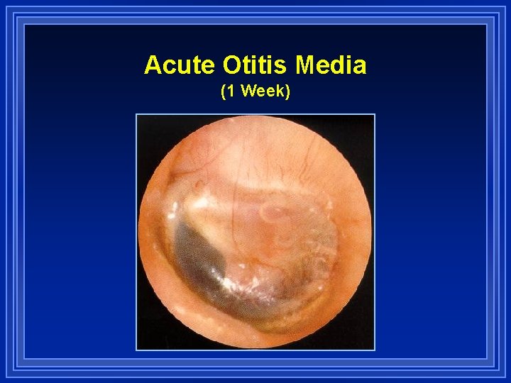 Acute Otitis Media (1 Week) 