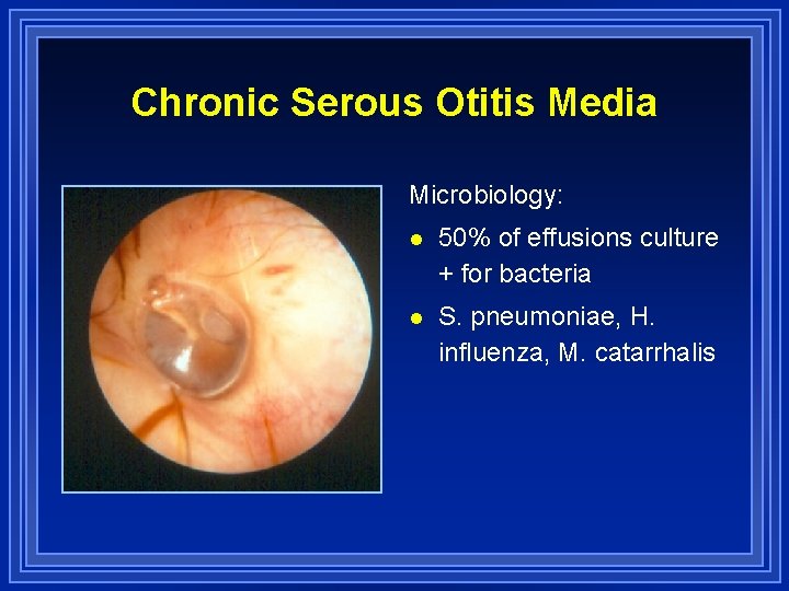 Chronic Serous Otitis Media Microbiology: l 50% of effusions culture + for bacteria l