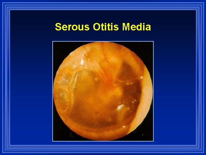Serous Otitis Media 