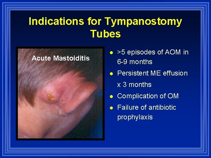 Indications for Tympanostomy Tubes Acute Mastoiditis l >5 episodes of AOM in 6 -9