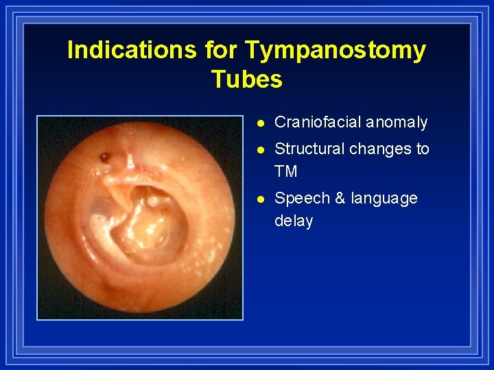 Indications for Tympanostomy Tubes l Craniofacial anomaly l Structural changes to TM l Speech
