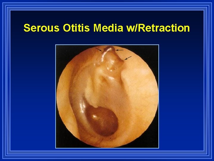 Serous Otitis Media w/Retraction 