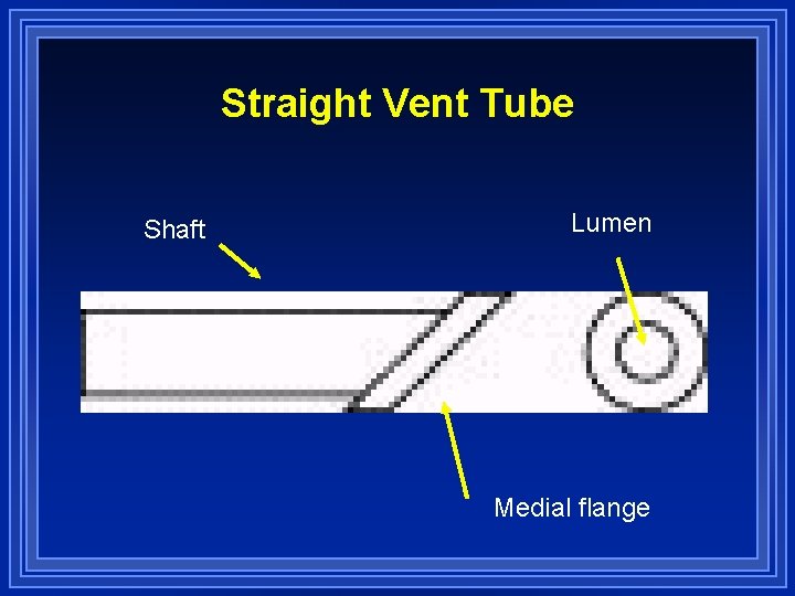 Straight Vent Tube Shaft Lumen Medial flange 