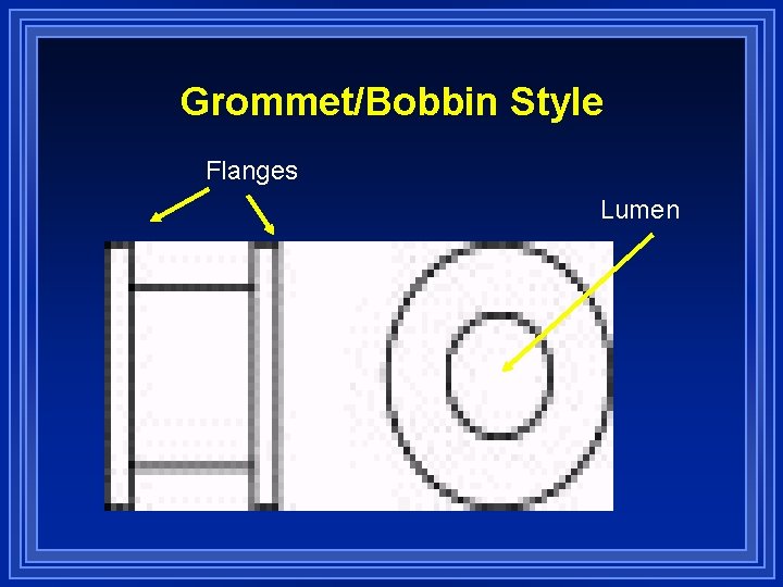 Grommet/Bobbin Style Flanges Lumen 