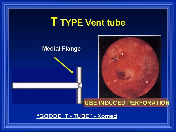 T TYPE Vent tube Medial Flange Shaft TUBE INDUCED PERFORATION “GOODE T - TUBE”