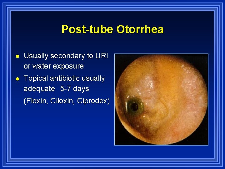 Post-tube Otorrhea l Usually secondary to URI or water exposure l Topical antibiotic usually
