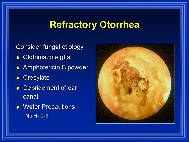 Refractory Otorrhea Consider fungal etiology l Clotrimazole gtts l Amphotericin B powder l Cresylate