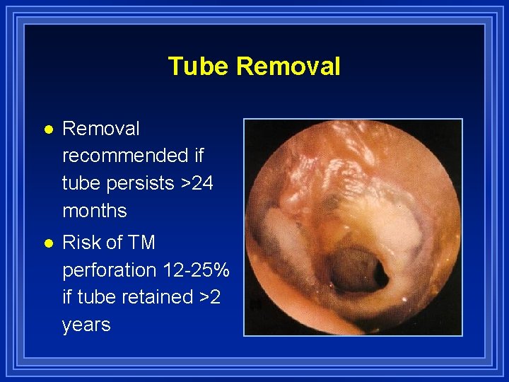 Tube Removal l Removal recommended if tube persists >24 months l Risk of TM